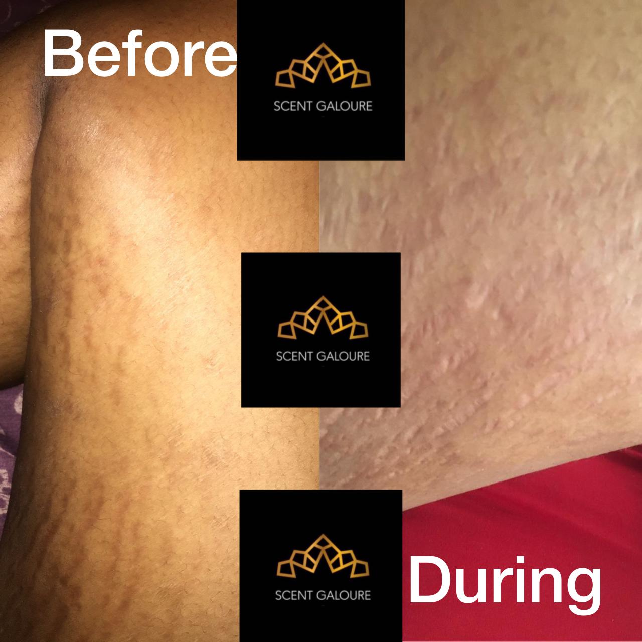 Stretchmarks Attack Body Combo