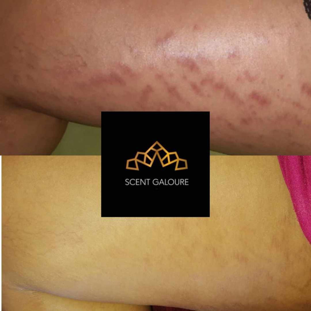 Stretchmarks Attack Body Combo