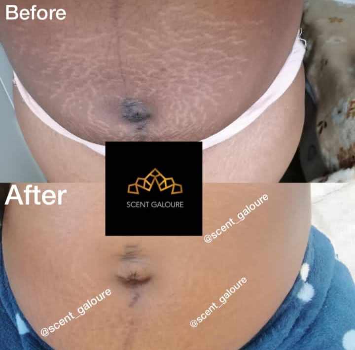 Stretchmarks Attack Body Combo