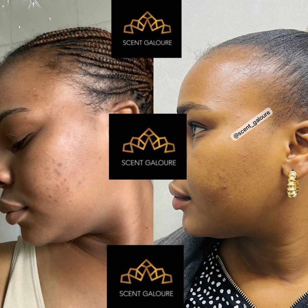 ACNE ON A BUDGET COMBO